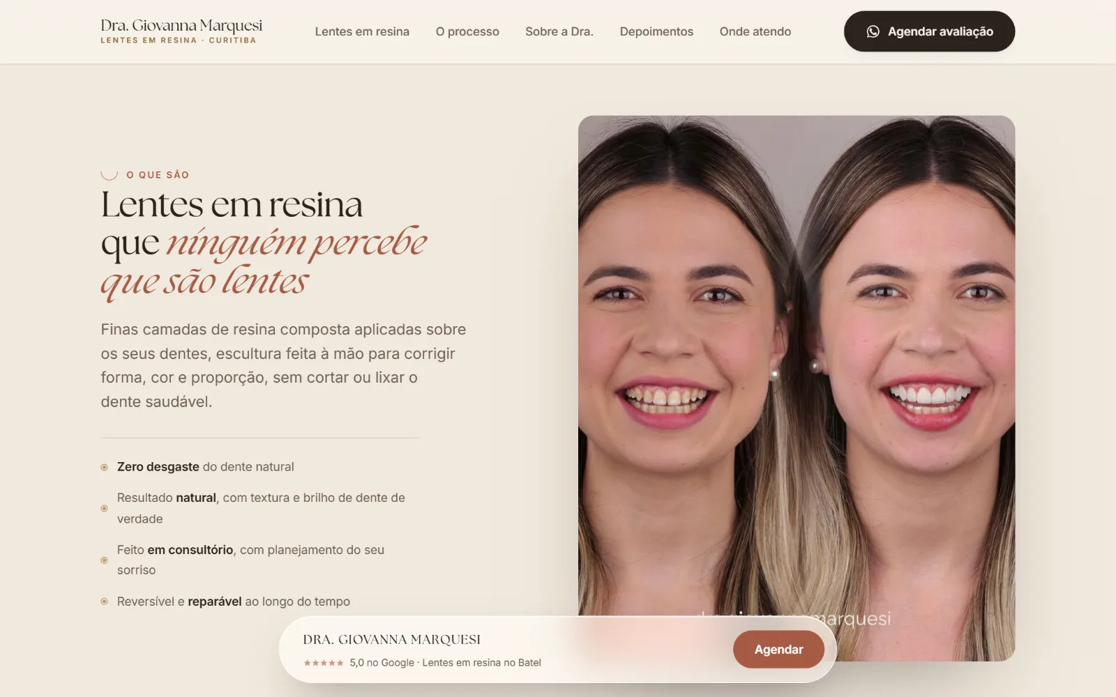 As lentes em resina explicadas, com o antes e depois de uma paciente.